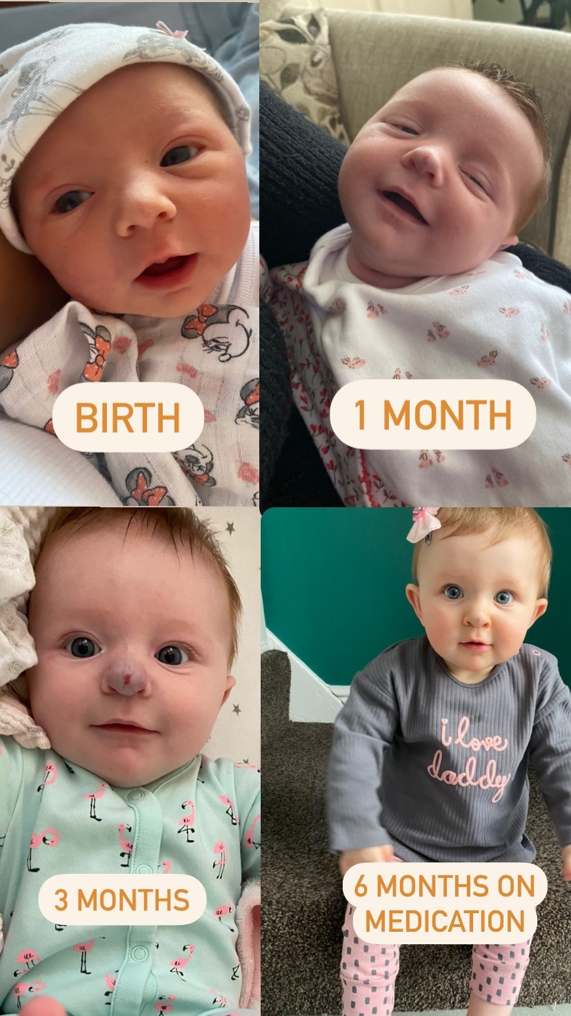 collage of Theia's hemangioma journey